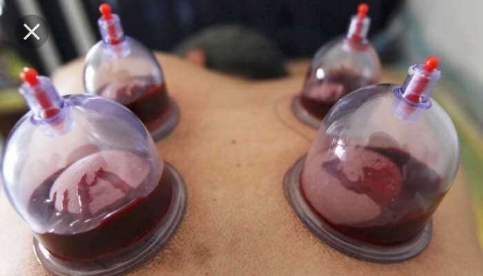 ventosa sangria